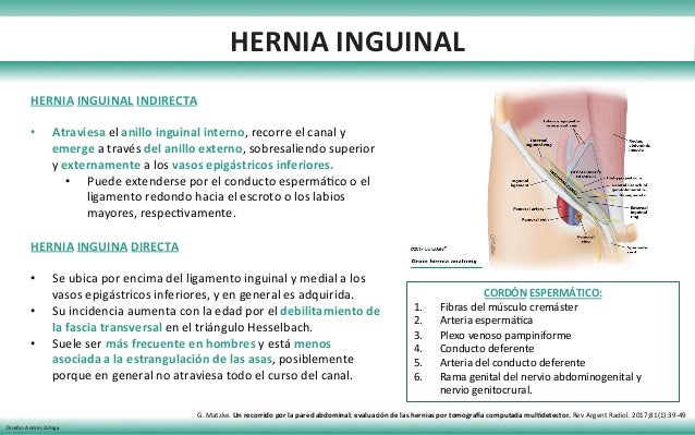 hernia inguinal indirecta